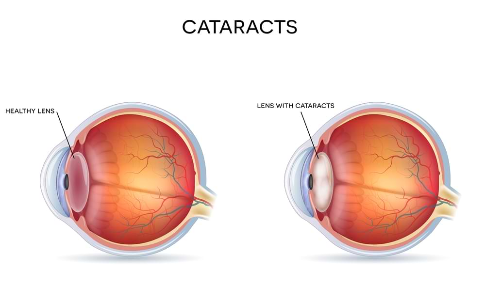 Cataract eye treatment in Melbourne.