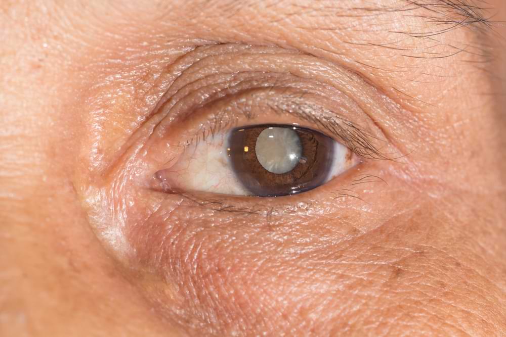 Cataract patient Melbourne