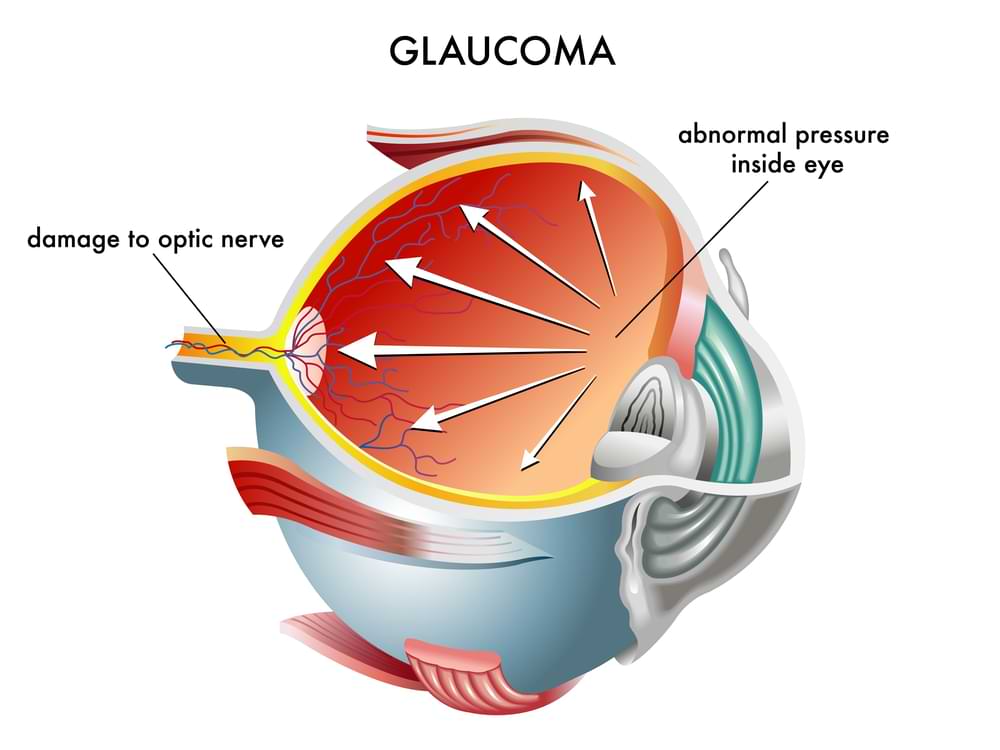 Glaucoma eye treatment Melbourne.