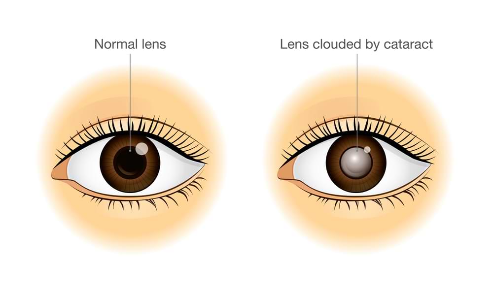 cataract eye exam in melbourne