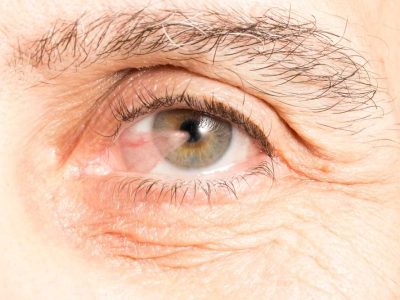 Pterygium Removal Treatment in Melbourne Victoria