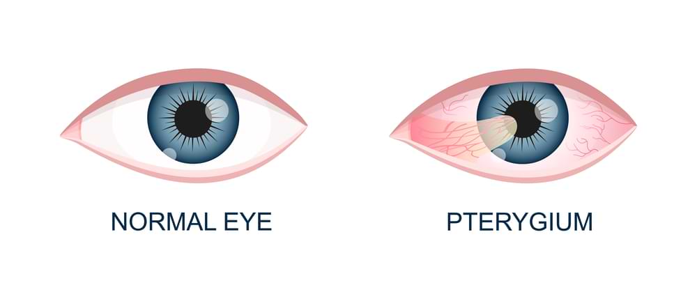 what is pterygium
